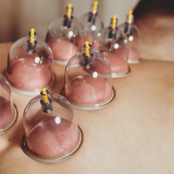 Schröpfmassage bei Cataleya Massage in Hoyerswerda